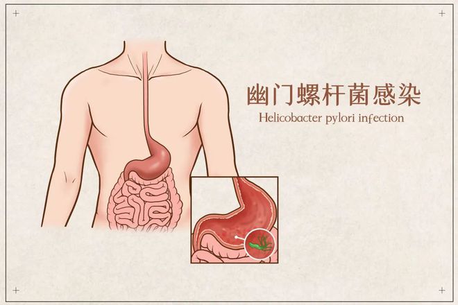 幽门螺杆菌的最新治疗方法